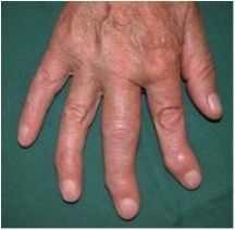 Multiple arthrotische Veränderungen der Fingergelenke – Polyarthrose